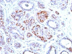 Immunohistochemical analysis of formalin-fixed, paraffin-embedded human breast carcinoma using Anti-GATA3 Antibody [GATA3/2442]