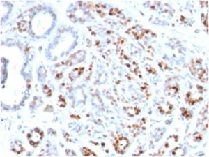 Immunohistochemical analysis of formalin-fixed, paraffin-embedded human breast carcinoma using Anti-GATA3 Antibody [GATA3/2444]