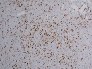 Immunohistochemical analysis of paraffin-embedded human Hemangioendothelioma using Anti-FLI1 Antibody