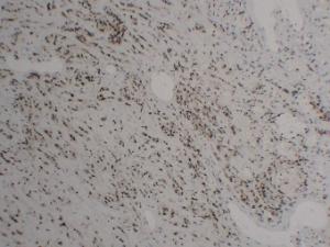 Immunohistochemical analysis of paraffin-embedded human Hemangioendothelioma using Anti-FLI1 Antibody