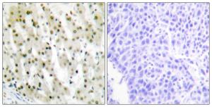 Immunohistochemical analysis of paraffin-embedded human liver carcinoma tissue using Anti-hnRNP A1 Antibody. The right hand panel represents a negative control, where the antibody was pre-incubated with the immunising peptide