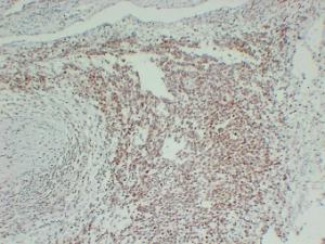 Immunohistochemical analysis of paraffin-embedded human PNET using Anti-FLI1 Antibody