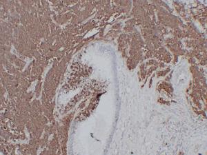 Immunohistochemical analysis of paraffin-embedded human Small cell lung carcinoma using Anti-CD56 Antibody