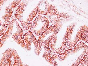 Immunohistochemical analysis of paraffin-embedded human Colon carcinoma using Anti-CD44 Antibody