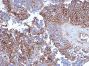 Immunohistochemical analysis of formalin-fixed, paraffin-embedded human ovarian carcinoma tissue using Anti-N Cadherin Antibody [CDH2/6857R]