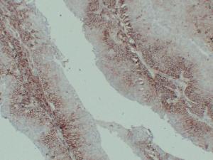 Immunohistochemical analysis of paraffin-embedded human Transitional cell carcinoma using Anti-CD44 Antibody