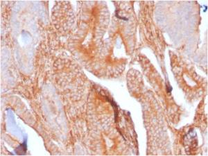 Immunohistochemical analysis of formalin-fixed, paraffin-embedded human prostate carcinoma using Anti-TAPA1 Antibody [C81/2885R]