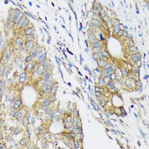 Immunohistochemistry analysis of paraffin-embedded human colon carcinoma tissue using Anti-CLCC1 Antibody (A305947) at a dilution of 1:100 (40X lens)