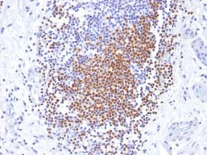 Immunohistochemical analysis of formalin-fixed, paraffin-embedded human urothelial carcinoma using Anti-PAX8 Antibody [PAX8/1492]