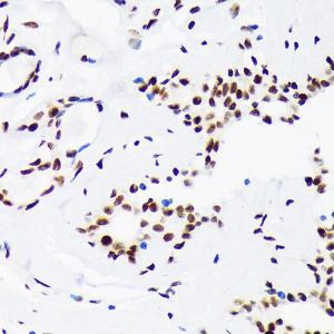 Immunohistochemistry analysis of paraffin-embedded human breast cancer tissue using Anti-LIG1 Antibody [ARC1514] (A307677) at a dilution of 1:100 (40x lens). Perform microwave antigen retrieval with 10 mM Tris/EDTA buffer pH 9.0 before commencing with IHC staining protocol.