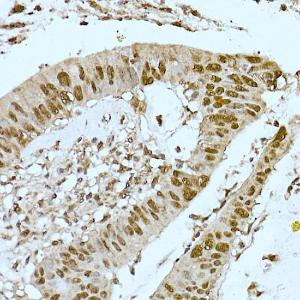 Immunohistochemistry analysis of paraffin-embedded human colon carcinoma tissue using Anti-CREBBP Antibody (A11437) at a dilution of 1:200 (40x lens). Perform high pressure antigen retrieval with 10 mM citrate buffer pH 6.0 before commencing with IHC staining protocol.