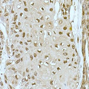 Immunohistochemistry analysis of paraffin-embedded human esophageal cancer using Anti-CREBBP Antibody (A11437) at a dilution of 1:200 (40x lens). Perform high pressure antigen retrieval with 10 mM citrate buffer pH 6.0 before commencing with IHC staining protocol.