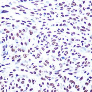 Immunohistochemistry analysis of paraffin-embedded human esophageal cancer using Anti-DNA PKcs Antibody (A11446) at a dilution of 1:100 (40x lens)