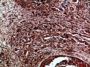 Immunohistochemical analysis of paraffin-embedded human breast cancer using Anti-RET Antibody