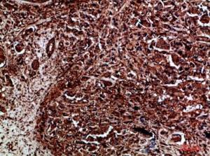 Immunohistochemical analysis of paraffin-embedded human breast cancer using Anti-RET Antibody