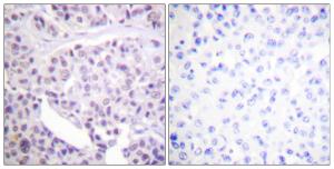 Immunohistochemical analysis of paraffin-embedded human breast carcinoma tissue using Anti-p53 Antibody. The right hand panel represents a negative control, where the antibody was pre-incubated with the immunising peptide.