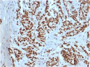 Immunohistochemical analysis of formalin-fixed, paraffin-embedded human colon using Anti-MSH2 Antibody [rMSH2/6548]