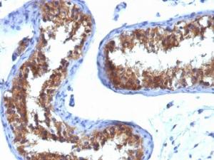 Immunohistochemical analysis of formalin-fixed, paraffin-embedded human testicular carcinoma using Anti-Major Vault Protein Antibody [1032]