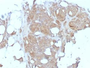 Immunohistochemical analysis of formalin-fixed, paraffin-embedded human breast carcinoma using Anti-Major Vault Protein Antibody [1032]