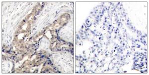 Immunohistochemical analysis of paraffin-embedded human breast carcinoma using Anti-Abl (phospho Tyr393 + Tyr412) Antibody. The right hand panel represents a negative control, where the antibody was pre-incubated with the immunising peptide