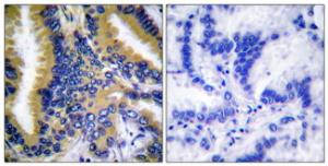 Immunohistochemical analysis of paraffin-embedded human lung carcinoma tissue using Anti-BIK Antibody. The right hand panel represents a negative control, where the Antibody was pre-incubated with the immunising peptide