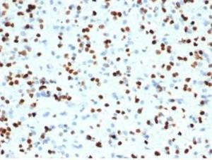 Immunohistochemical analysis of formalin-fixed, paraffin-embedded human brain tissue using Anti-OLIG2 Antibody [OLIG2/7074R]