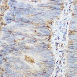 Immunohistochemistry analysis of paraffin-embedded human colon carcinoma tissue using Anti-beta 2 Microglobulin Antibody (A11459) at a dilution of 1:200 (40X lens). Perform high pressure antigen retrieval with 10 mM citrate buffer pH 6.0 before commencing with IHC staining protocol