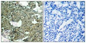 Immunohistochemical analysis of paraffin-embedded human breast carcinoma using Anti-MEK1 + MEK2 (phospho Ser221) Antibody The right hand panel represents a negative control, where the antibody was pre-incubated with the immunising peptide