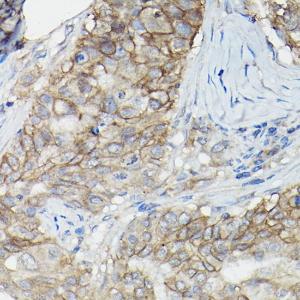 Immunohistochemistry analysis of paraffin-embedded human breast cancer tissue using Anti-CD147 Antibody (A11460) at a dilution of 1:100 (40X lens). Perform high pressure antigen retrieval with 10 mM citrate buffer pH 6.0 before commencing with IHC staining protocol