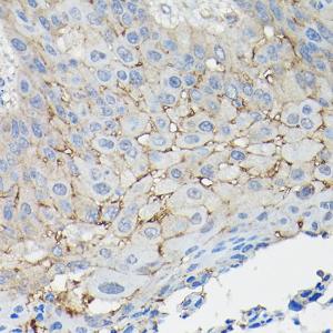 Immunohistochemistry analysis of paraffin-embedded human esophageal cancer using Anti-CD147 Antibody (A11460) at a dilution of 1:100 (40X lens). Perform high pressure antigen retrieval with 10 mM citrate buffer pH 6.0 before commencing with IHC staining protocol