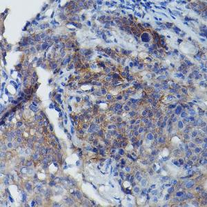 Immunohistochemistry analysis of paraffin-embedded human cervix cancer tissue using Anti-CD147 Antibody (A11460) at a dilution of 1:100 (40X lens). Perform high pressure antigen retrieval with 10 mM citrate buffer pH 6.0 before commencing with IHC staining protocol