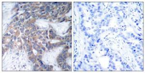 Immunohistochemical analysis of paraffin-embedded human breast carcinoma using Anti-MEK1 + MEK2 (phospho Ser217) Antibody. The right hand panel represents a negative control, where the antibody was pre-incubated with the immunising peptide.