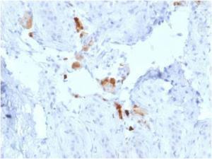 Immunohistochemical analysis of formalin-fixed, paraffin-embedded human testicular carcinoma using Anti-Calretinin Antibody [CALB2/2786]