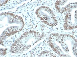 Immunohistochemical analysis of formalin-fixed, paraffin-embedded human prostate carcinoma using Anti-FOXP1 Antibody [FOXP1/44R]