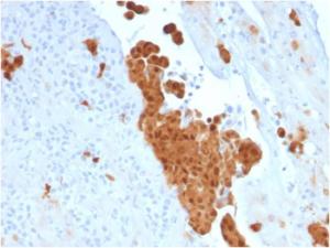 Immunohistochemical analysis of formalin-fixed, paraffin-embedded human mesothelioma using Anti-Calretinin Antibody [CALB2/2786]