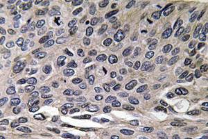 Immunohistochemical analysis of paraffin-embedded human lung carcinoma tissue using Anti-MIP-1alpha Antibody