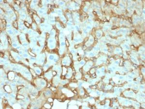 Immunohistochemical analysis of formalin-fixed, paraffin-embedded human hepatocellular carcinoma using Anti-Albumin Antibody [ALB/2141]