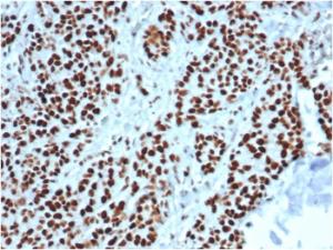 Immunohistochemical analysis of formalin-fixed, paraffin-embedded human colon using Anti-MSH2 Antibody [MSH2/6549R]