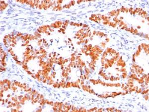 Immunohistochemical analysis of formalin-fixed, paraffin-embedded human colon carcinoma using Anti-p53 Antibody [BP53-12]