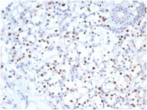 Immunohistochemical analysis of formalin-fixed, paraffin-embedded human kidney cancer using Anti-p57 Kip2 Antibody [KIP2/7083R] at 2 µg/ml in PBS for 30 minutes at room temperature