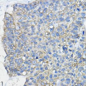 Immunohistochemistry analysis of paraffin-embedded human lung cancer using Anti-CD46 Antibody (A11467) at a dilution of 1:100 (40X lens). Perform high pressure antigen retrieval with 10 mM citrate buffer pH 6.0 before commencing with IHC staining protocol