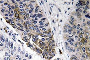 Immunohistochemical analysis of paraffin-embedded human lung carcinoma tissue using Anti-IgA Antibody