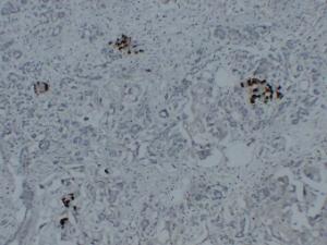 Immunohistochemical analysis of paraffin-embedded human Pancreatic carcinoma using Anti-Glucagon Antibody