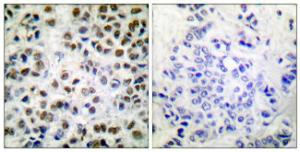 Immunohistochemical analysis of paraffin-embedded human breast carcinoma using Anti-POLR2A (phospho Ser1619) Antibody. The right hand panel represents a negative control, where the antibody was pre-incubated with the immunising peptide