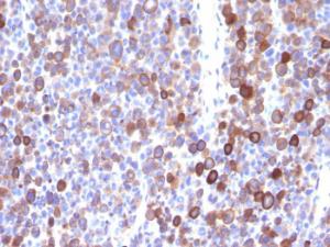 Immunohistochemical analysis of formalin-fixed, paraffin-embedded human melanoma using Anti-Moesin Antibody [MSN/491]