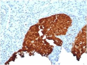 Immunohistochemical analysis of formalin-fixed, paraffin-embedded human cervix tissue using Anti-p16INK4a Antibody [CDKN2A/4844R]