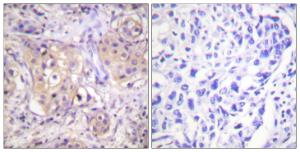 Immunohistochemical analysis of paraffin-embedded human breast carcinoma using Anti-PKC-pan (phospho Thr497) Antibody. The right hand panel represents a negative control, where the antibody was pre-incubated with the immunising peptide.