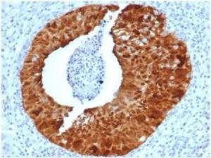 Immunohistochemical analysis of formalin-fixed, paraffin-embedded human cervix tissue using Anti-p16INK4a Antibody [CDKN2A/4844R]