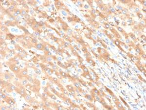 Immunohistochemical analysis of formalin-fixed, paraffin-embedded human liver carcinoma in colon using Anti-Albumin Antibody [ALB/6411R]