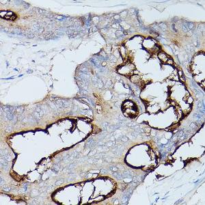 Immunohistochemistry analysis of paraffin-embedded human colon carcinoma tissue using Anti-CEACAM1 Antibody (A11472) at a dilution of 1:100 (40X lens). Perform high pressure antigen retrieval with 10 mM citrate buffer pH 6.0 before commencing with IHC staining protocol